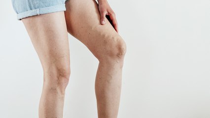 bd-ayuda-de-fisioterapia-en-problemas-venosos-101122