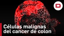 Científicos españoles descubren células malignas responsables de las metástasis del cáncer de colon