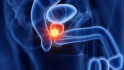 bd-cancer-de-prostata-en-hombres-jovenes-111122