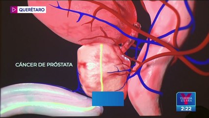 Hospital Ángeles Querétaro es el primero en ofrecer cirugías robóticas