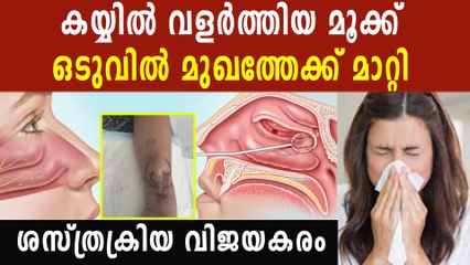 കയ്യിൽ വളർത്തിയ യുവതിയുടെ മൂക്ക് ശസ്ത്രക്രിയ ചെയ്ത് മുഖത്തേക്ക് മാറ്റി