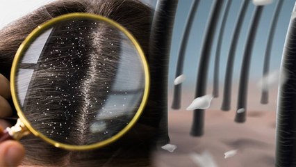 सर्दियों में डैंड्रफ क्यों होता है, सर्दियों में डैंड्रफ होने का क्या कारण है |Boldsky*Entertainment