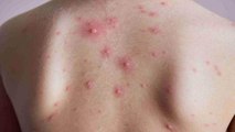 खसरा क्यों होता है | खसरा के कारण और लक्षण | Measles Symptoms | Boldsky *health