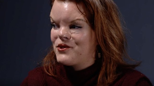 Clémence Bellanger, atteinte de malformations physiques : C'est à l'école que j'ai compris ma différence, on me demandait pourquoi j'étais comme ça