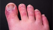 Covid-19: This uncommon symptom affects the limps. Here how to spot it