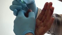 Parmağı koptuktan 8 saat sonra hastaneye giden işçinin parmağı kurtarıldı