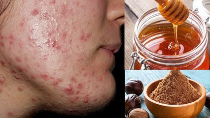 गांठ वाले पिंपल्स से छुटकारा दिलाएंगे ये उपाय | गांठ वाले पिंपल्स क्या है | Boldsky *Health