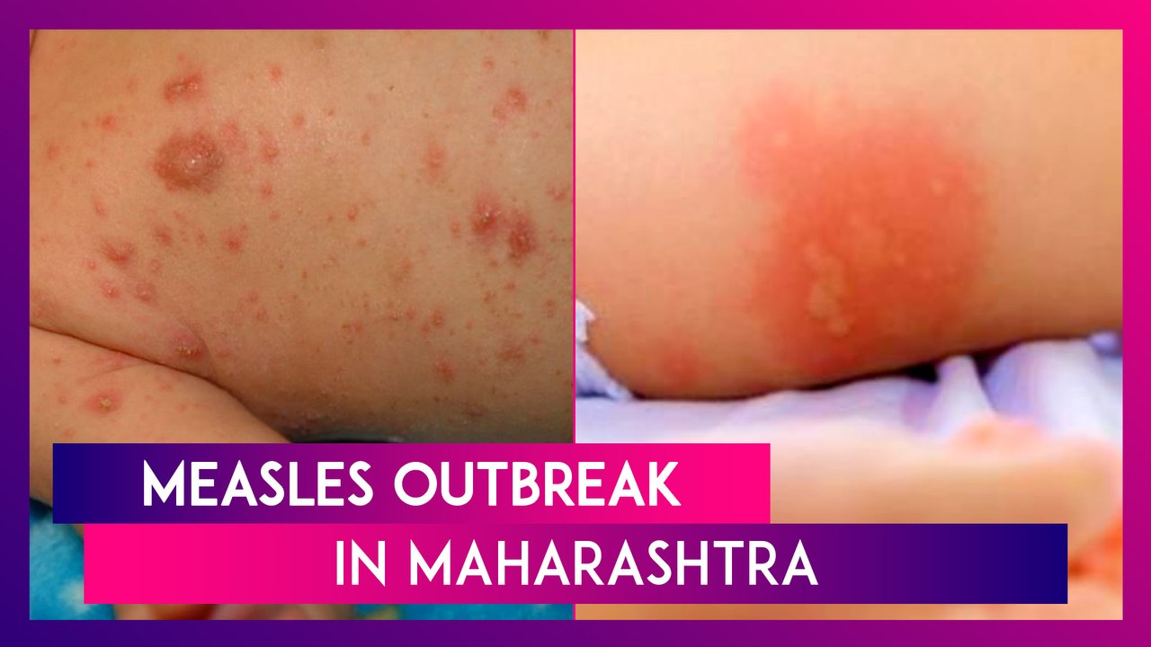 Measles Outbreak In Maharashtra: 538 Confirmed...