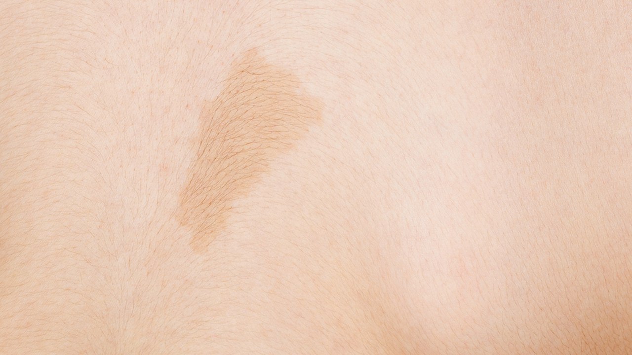 Café au lait Flecken beim Kind: Das bedeuten die hellbraunen Hautverfärbungen