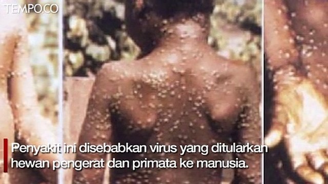 Cegah Penularan Cacar Monyet, Kenali Gejalanya