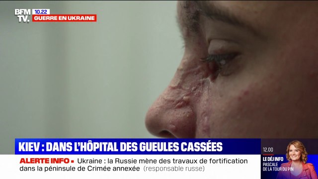 C'est dur de voir mon visage comme ça : des Ukrainiens défigurés par les frappes russes témoignent