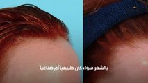 إيجابيات وسلبيات زراعة الشعر في الصيف