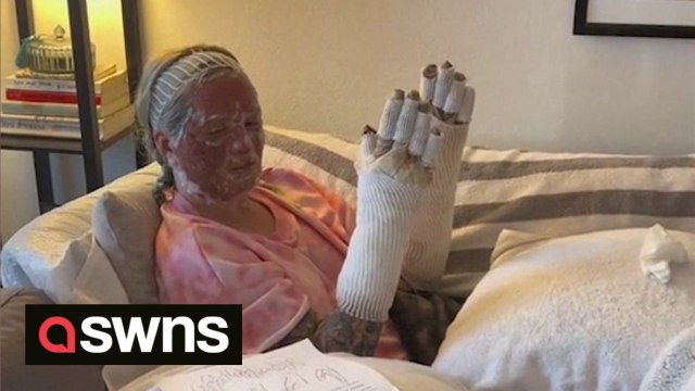 Woman says she looks like a snack after enduring 7-month burns recovery when firepit turned into a 'flamethrower'