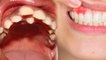 दांत के ऊपर दांत क्यों चढ़ते हैं, चौंका देगी वजह |Why do teeth climb on teeth, the reason |*Health
