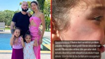 Berkay Şahin'in kızının yüzüne dolap kapağı düştü! Yaralanan evladını paylaşan anne, ateş püskürdü