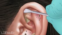 ASMR Satisfying _ ear pimple blackhead care _ ear exfoliation _ sebaceous cyst removal _ tingle
