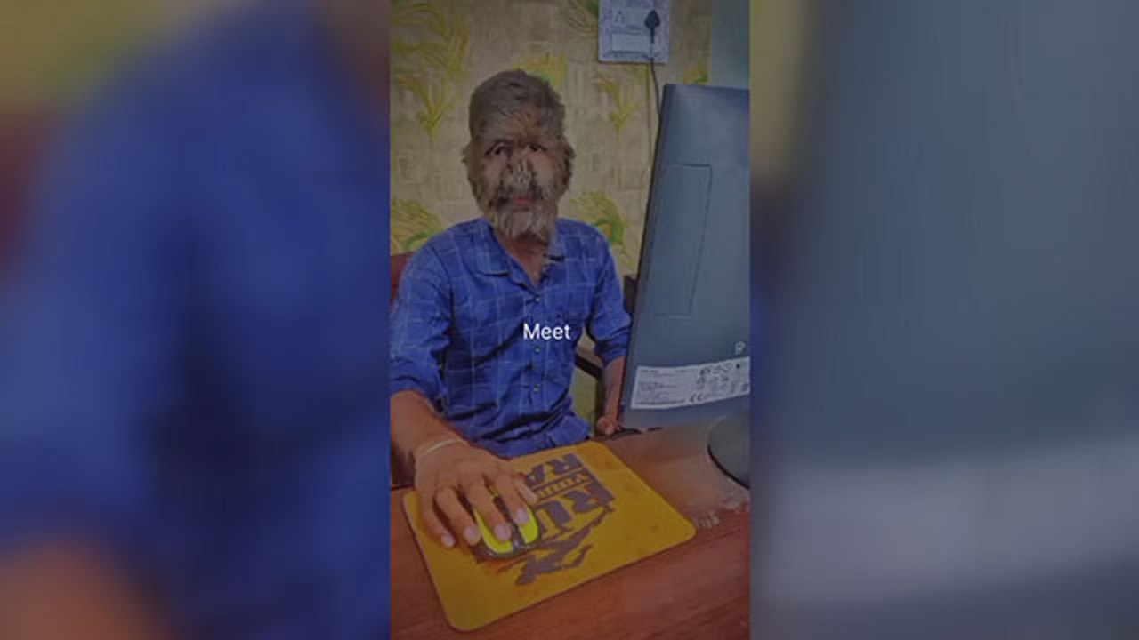 Dünyanın en tuhaf hastalıklarından birine sahip: Yaşayan ‘Kurt Adam'