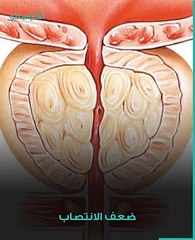 ما هو سرطان البروستاتا؟