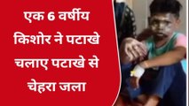 श्योपुर : 6 साल का मासूम बच्‍चा पटाखे जलाते समय झुलसा, अस्‍पताल में उपचार जारी