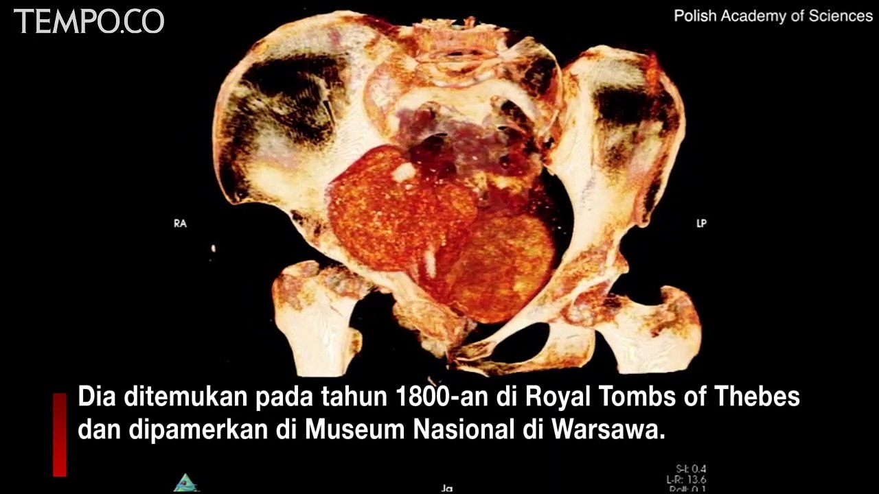 Berumur 2 Ribu Tahun, Mumi Mesir Kuno Hamil Pertama di Dunia Ditemukan