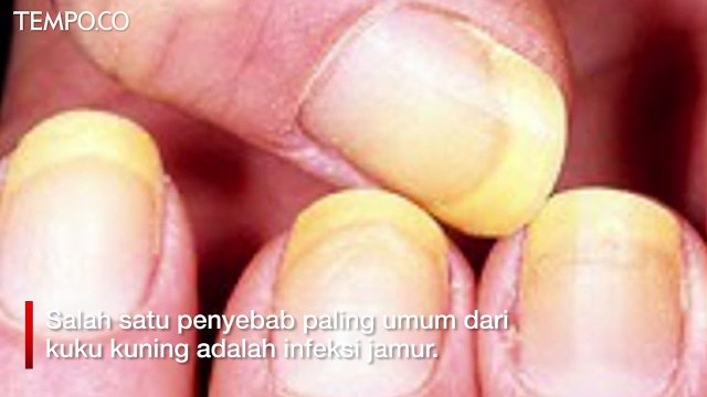 Aneka Penyakit Ini Bisa Dikenali dari Tanda di Kuku