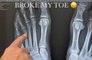 Travis Barker breaks his toe