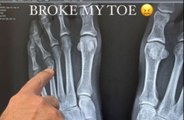 Travis Barker breaks his toe
