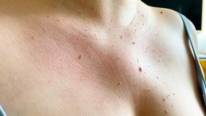 Peeling lotion rolls away dry and dead skin