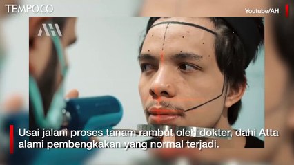 Atta Halilintar Liburan di Turki Sekalian Tanam Rambut agar Lebih Percaya Diri