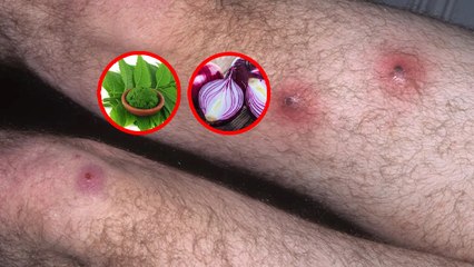 बालतोड़ से तुरंत राहत पाने के लिए करें ये घरेलू उपाय, बालतोड़ का इलाज | Boldsky *Health