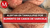 Casos de varicela se multiplican en Tamaulipas; registro crece 531.8%