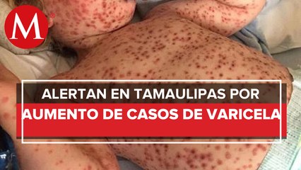 Casos de varicela se multiplican en Tamaulipas; registro crece 531.8%