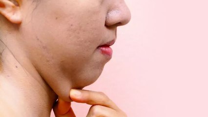 चेहरे की चरबी क्यों बढ़ती है, चेहरे की चरबी कैसे कम करें |Boldsky*Health