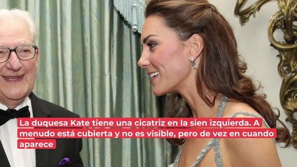 ¿Es inofensiva? La historia detrás de la cicatriz en la frente de la princesa Kate