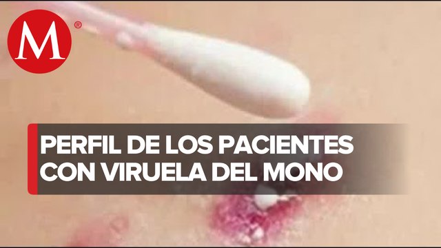 Durante el 2022, México ha registrado 3 mil 292 casos de viruela símica