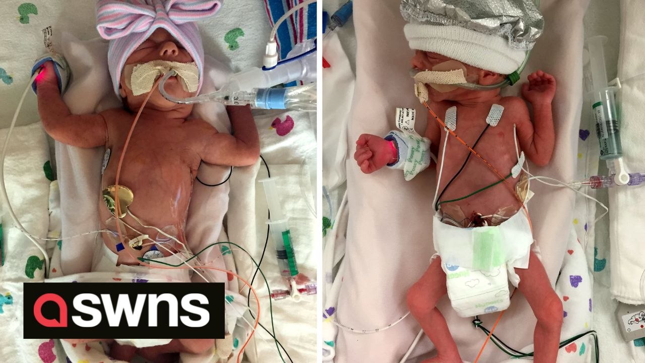 Twin saves sister’s life by sending out distress signals prompting doctors to deliver them