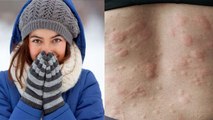 ऊनी कपड़े पहनने से क्यों होती है एलर्जी ,स्किन पर ऊनी कपड़े पहनने से एलर्जी का कारण |Boldsky *Health