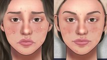 [ASMR] Acne, Big Blackhead Removal Animation best short video