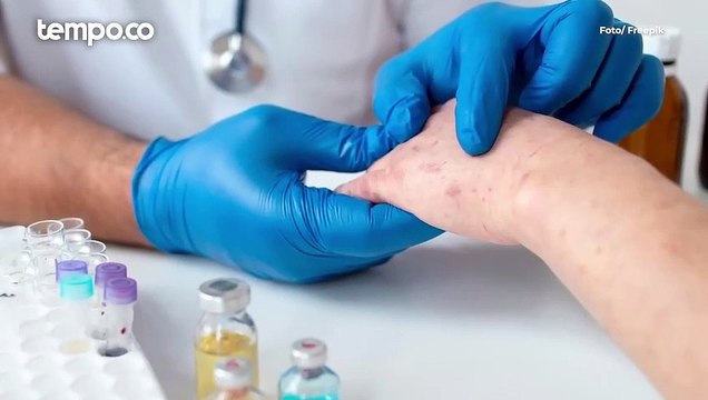 Bagaimana Penularan Cacar Monyet?