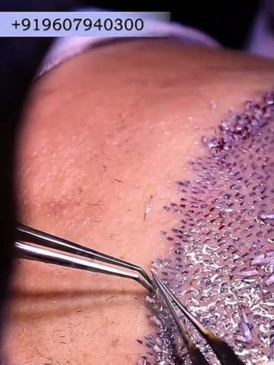 Hair Implantation by Experts -- #shorts -- Hair Transplantation Procedure Live