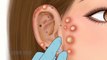 ASMR Pimple blackhead and sebaceous cyst removal for gamer | Massage ear - Tingle animation #ASMRDRM  #removeearwax #eartreatment #asmr