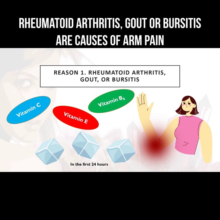 Rheumatoid arthritis, gout or bursitis are causes of arm pain