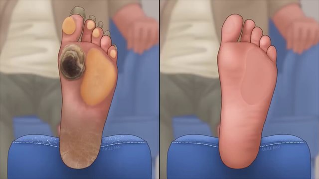 ASMR Treatment of severely hard and cracked feet | Calluses, Plantar Warts, Corn animesh playing satisfying video