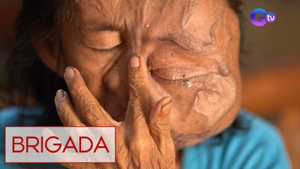 Babae, tinubuan ng higanteng bukol sa mukha! | Brigada