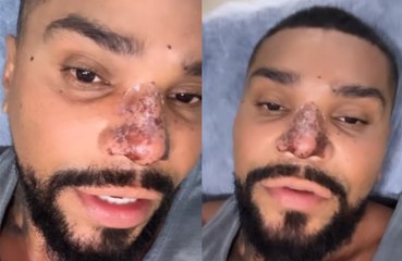 Naldo enfrenta princípio de necrose após procedimento estético no nariz