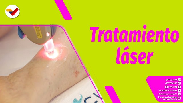 Buena Vibra | Tratamiento de las venas varicosas con punta de láser
