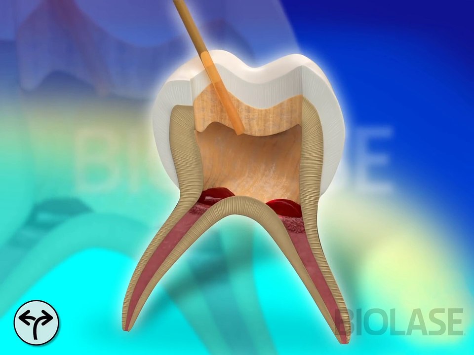 Waterlase Laser Dentistry for Dental Restoration - BIOLASE