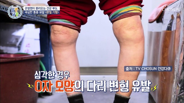 관절 기형?! 유발까지 초래하는 심각한 연골 손상 TV CHOSUN 20221201 방송