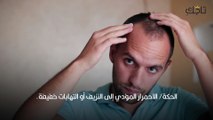 الدهني وتساقط الشعر