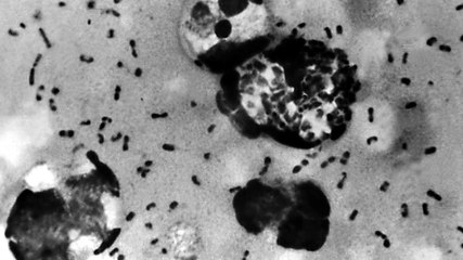 What is Strep A and what are the symptoms?